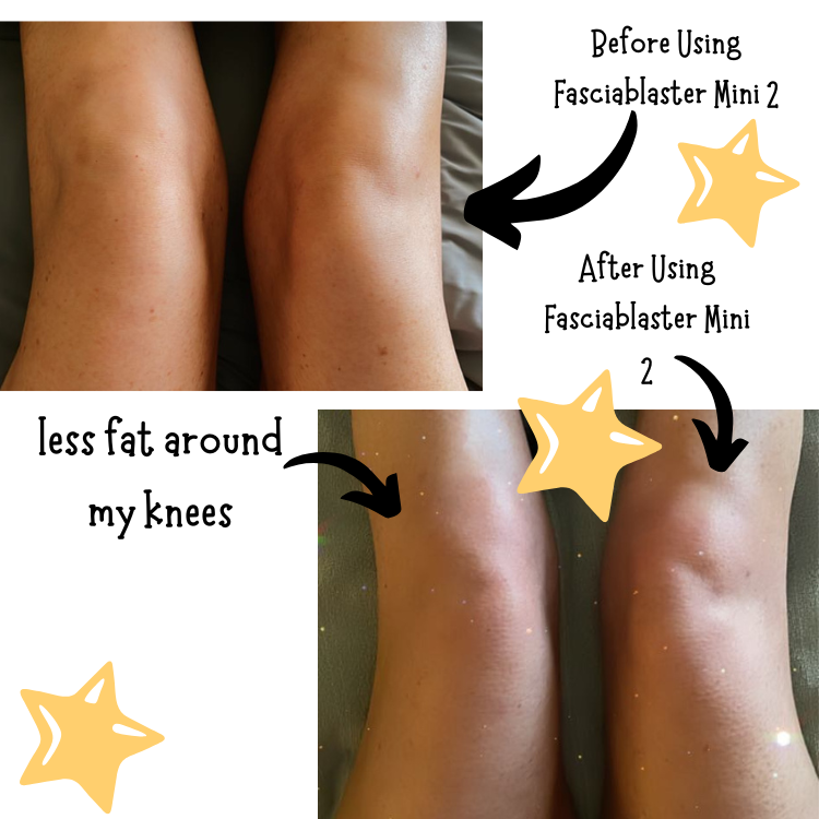 How to Get Rid of Knee Fat: This Is What Worked For Me